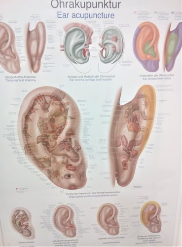 Ohrakupunktur